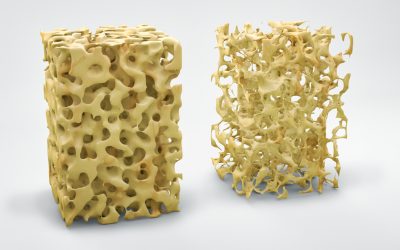 Exercise Against Osteoporosis
